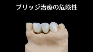 ブリッジ治療の危険性